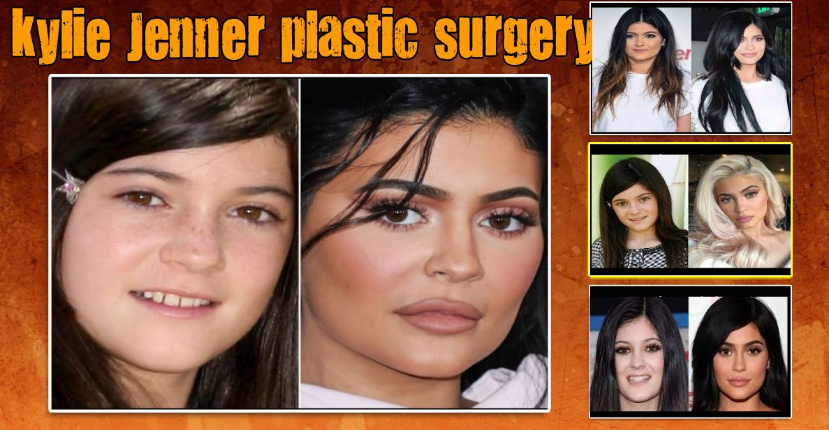 kylie jenner plastic surgery
