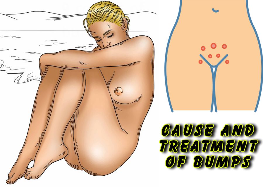 causes and treatment of bumps on vagina